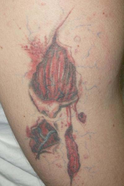 Can you Tattoo over Varicose Veins
